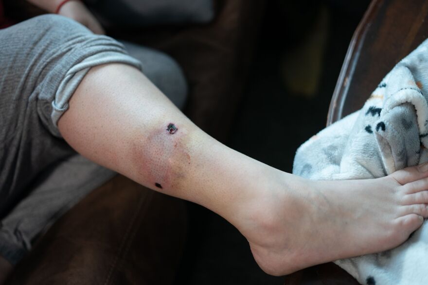 Emily Tavis considered declining an ambulance ride after being shot in the leg at the Kansas City Chiefs Super Bowl parade because she was worried about cost. She started a new job 12 days after the parade, but even now that she has health insurance through work, she is attuned to the costs of seeking care.